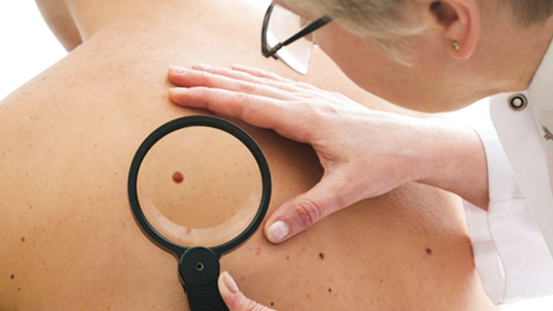 Бесплатно проверить родинки на злокачественность можно будет в ЦУМе и в ТЦ «Радуга»